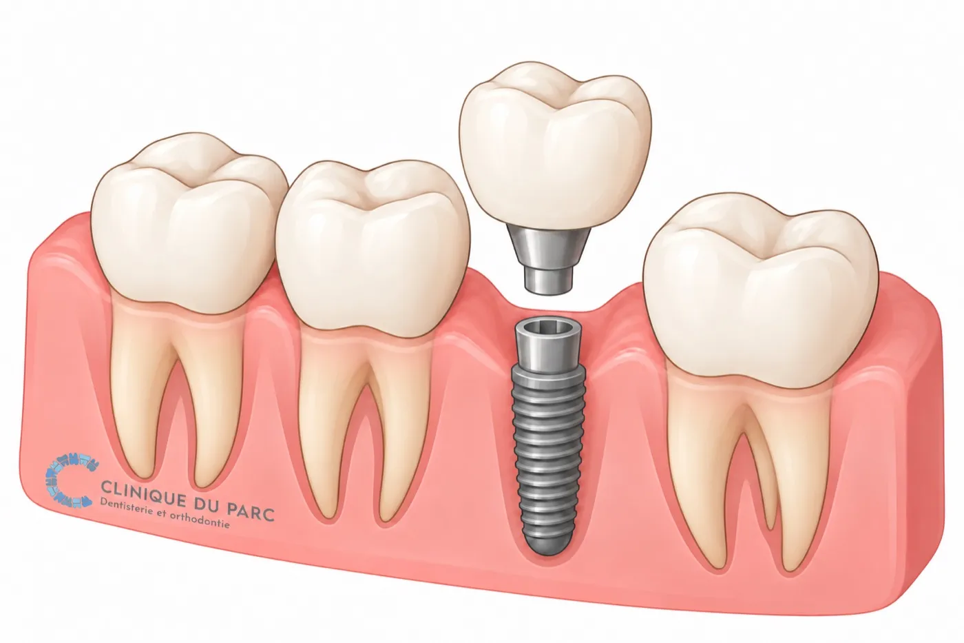 Couronne et pièce de connexion au-dessus de l’implant